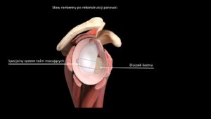 Nowatorska rekonstrukcja barku w Chorzowie z użyciem taśm stabilizujących