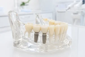 Czy badanie krwi pomoże przewidzieć utratę implantu zębowego? Naukowcy z UMW prowadzą badania