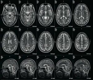 Pierwszy komercyjny implant mózg–komputer wszczepiony pacjentowi. Chiny wyprzedziły Neuralink